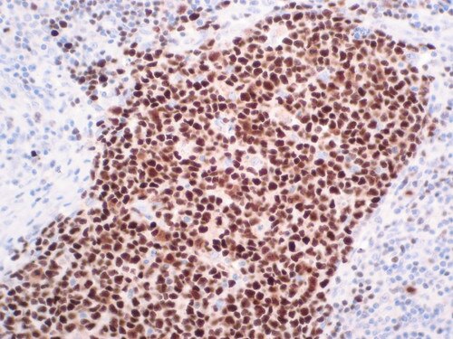 IHC of OCT-2 on an FFPE Lymphoma Tissue